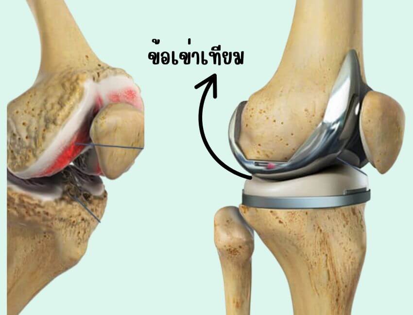 ข้อเข่าเทียม