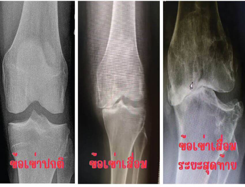 โรคข้อเข่าเสื่อม