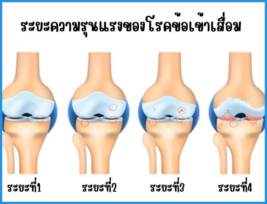 โรคข้อเข่าเสื่อม