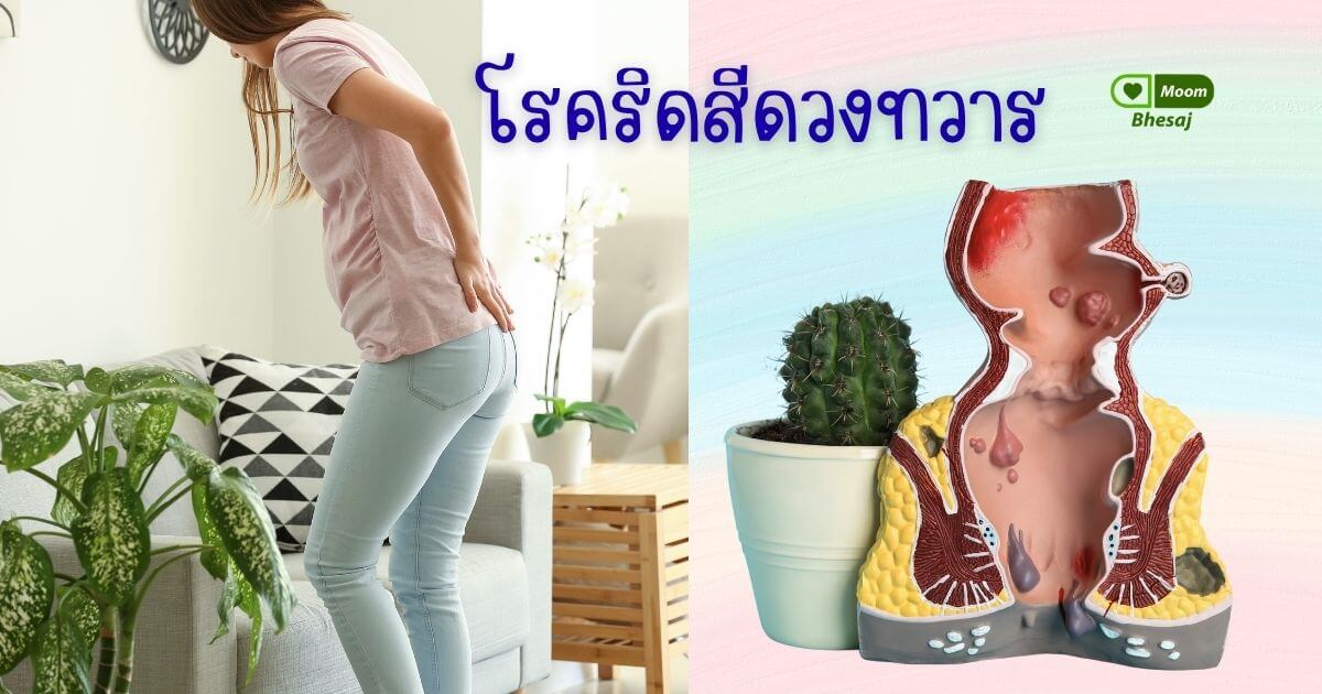 โรคริดสีดวงทวาร