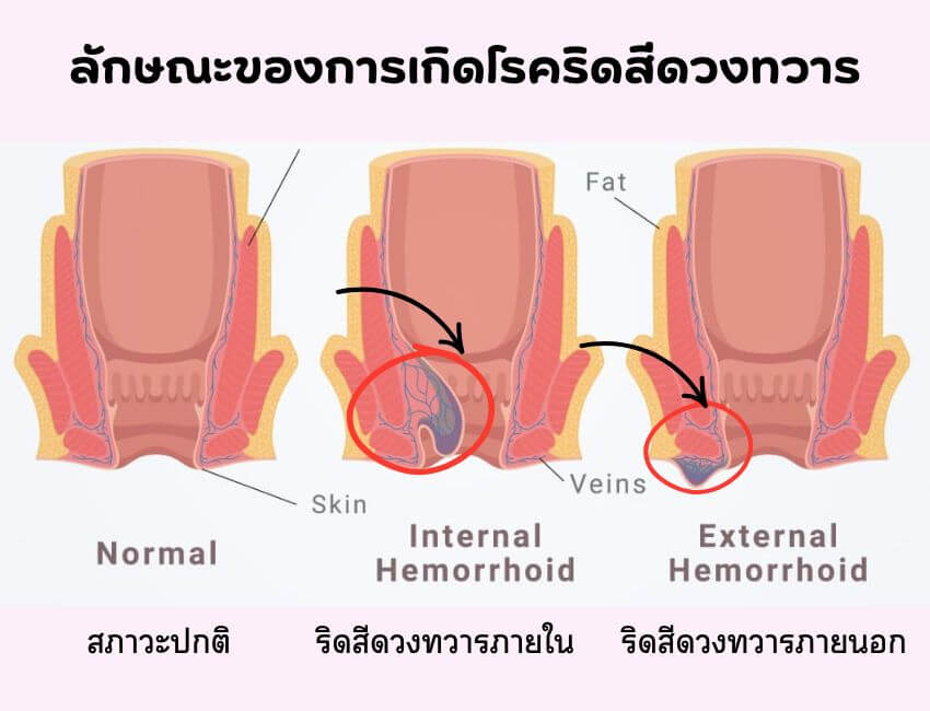ริดสีดวงทวารภายในและภายนอก
