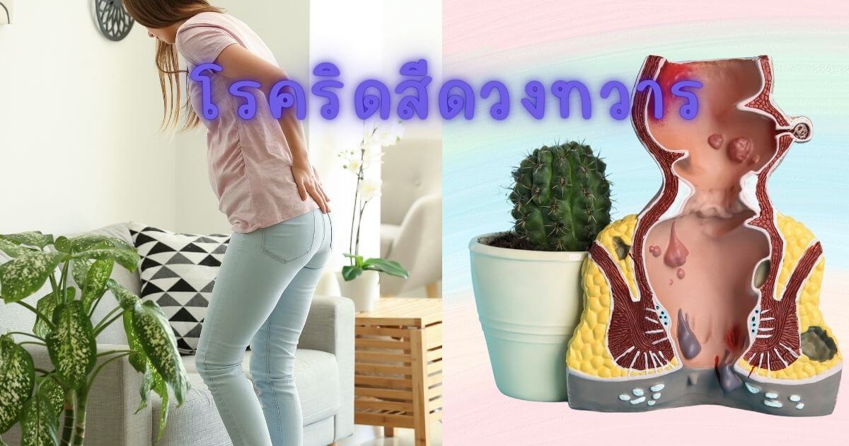 ริดสีดวงทวาร