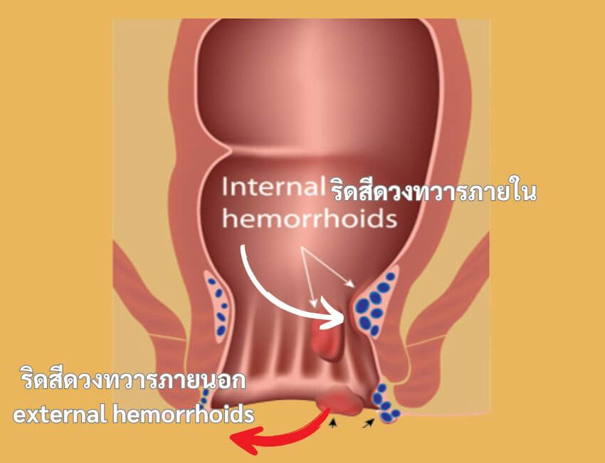 ประเภทของโรคริดสีดวงทวาร