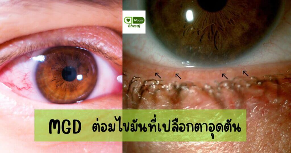 โรคต่อมไขมันที่เปลือกตาอุดตัน
