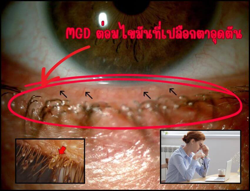 โรคต่อมไขมันที่เปลือกตาอุดตัน