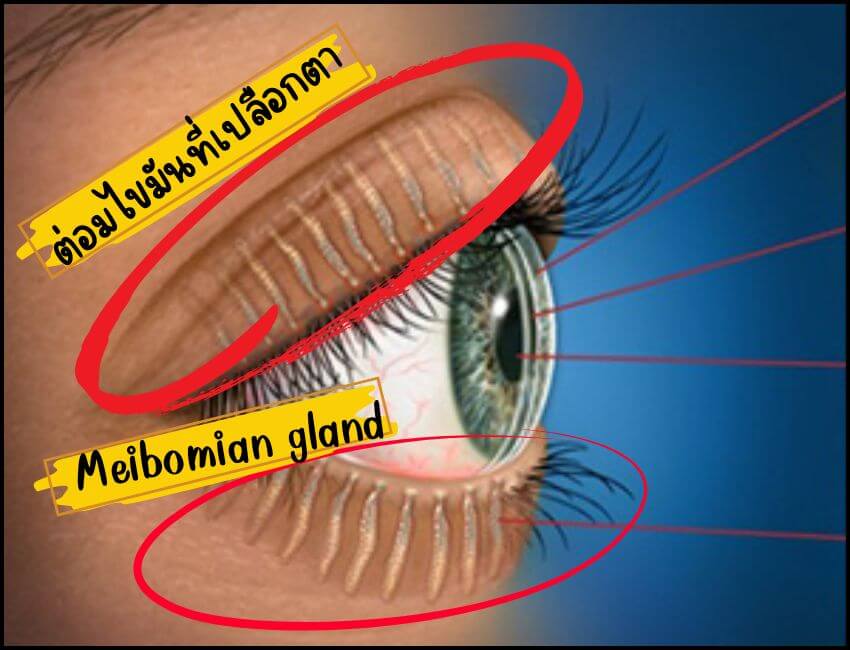 โรคต่อมไขมันที่เปลือกตาอุดตัน