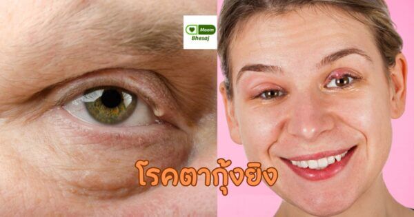 โรคตากุ้งยิง