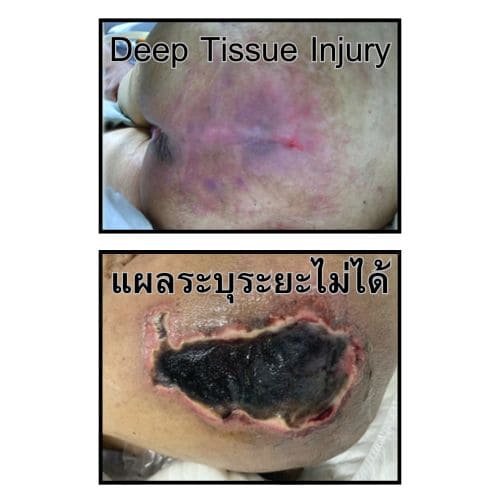 deep tissue injury