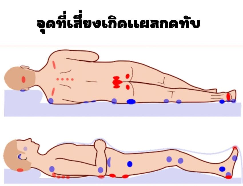 ตำแหน่งที่เกิดแผลกดทับได้ในผู้ป่วยติดเตียง