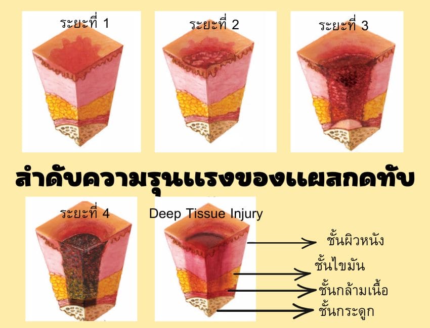 ระดับความรุนแรงของแผลกดทับ