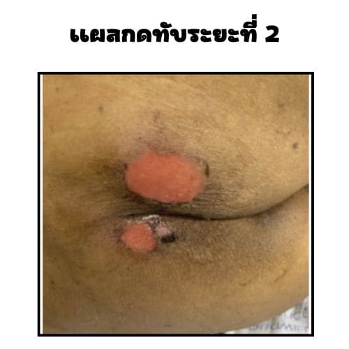 แผลกดทับระยะที่ 2