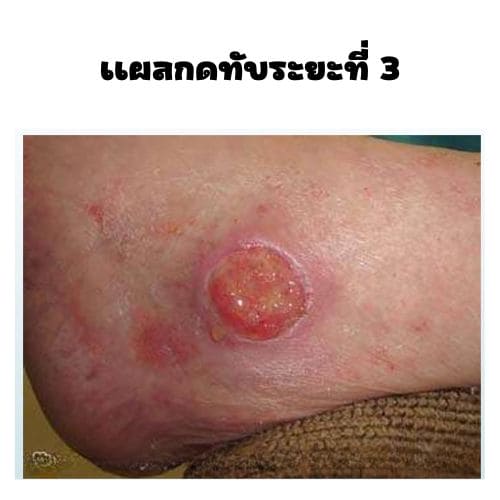 แผลกดทับระยะที่ 3