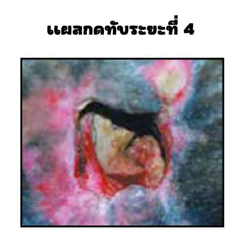 แผลกดทับระยะที่ 4