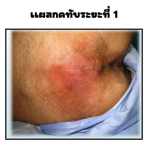แผลกดทับระยะที่ 1